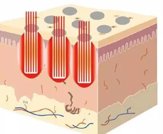 點(diǎn)陣激光副作用、風(fēng)險(xiǎn)是什么?