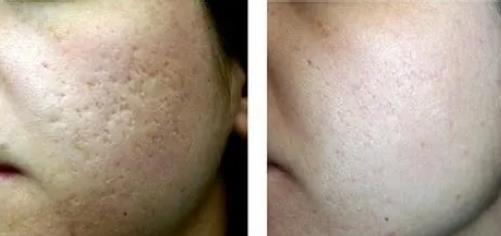 點(diǎn)陣激光的優(yōu)點(diǎn)是什么，如何保養(yǎng)？