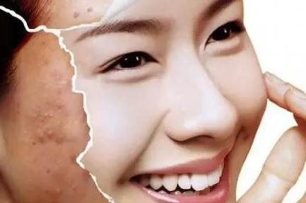 激光去痣要多少錢?貴嗎?