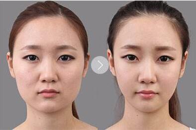 打注射瘦臉臉部會(huì)有凹陷嗎