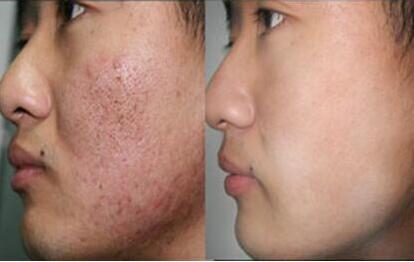 激光去痘印會(huì)不會(huì)產(chǎn)生副作用和后遺癥