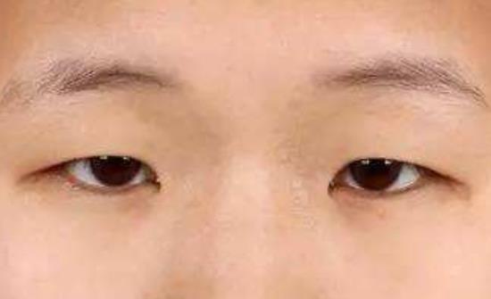 上瞼下垂是不是遺傳的?遺傳性上瞼下垂有哪些類型