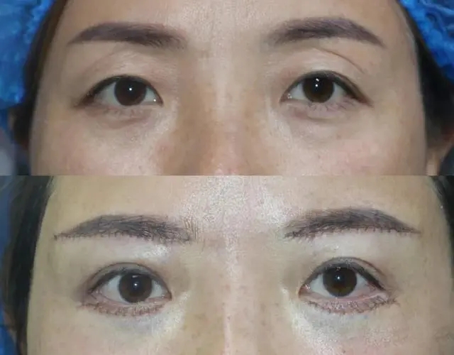 男人做提眉術(shù)好嗎?用三角眼做提眉術(shù)果好嗎?