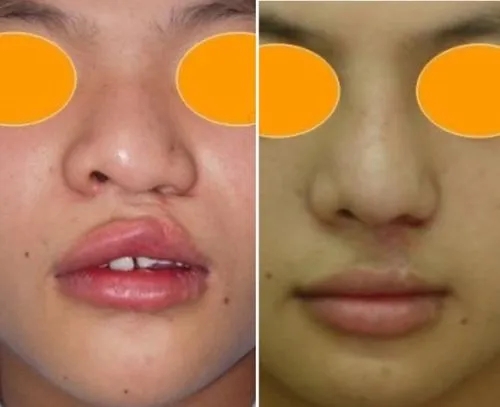 兔唇必須要修復嗎?怎么修復兔唇?