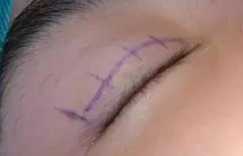 埋線雙眼皮的維護時間的影響因素是什么？