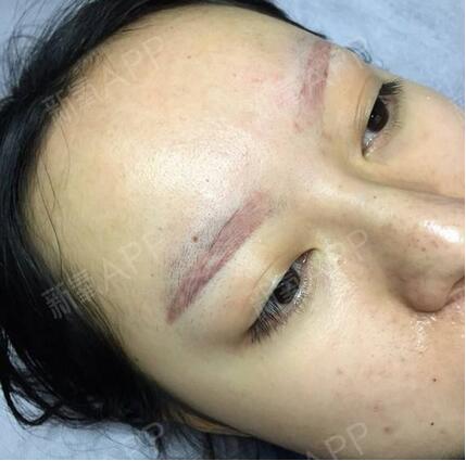 激光洗眉后多長(zhǎng)時(shí)間可以沾水?