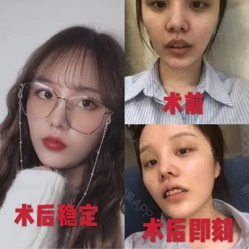 唇部缺損重建手術(shù)果好嗎?