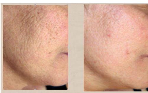 點(diǎn)陣激光多長時(shí)間可以洗臉？