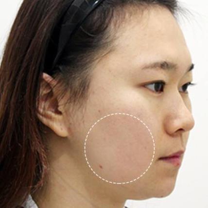 磨骨整形是否沒(méi)問(wèn)題，磨骨后可以熱敷嗎