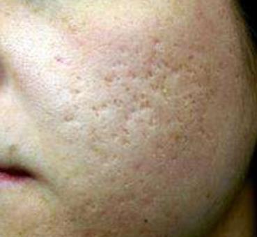 點陣激光祛痘印有什么副作用和注意事項