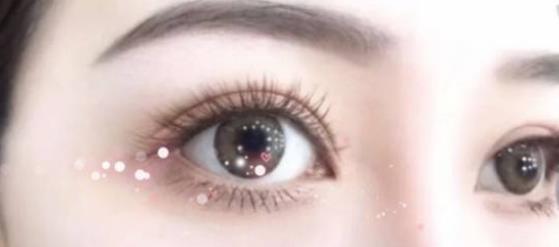 哪6種情況需要雙眼皮修復?