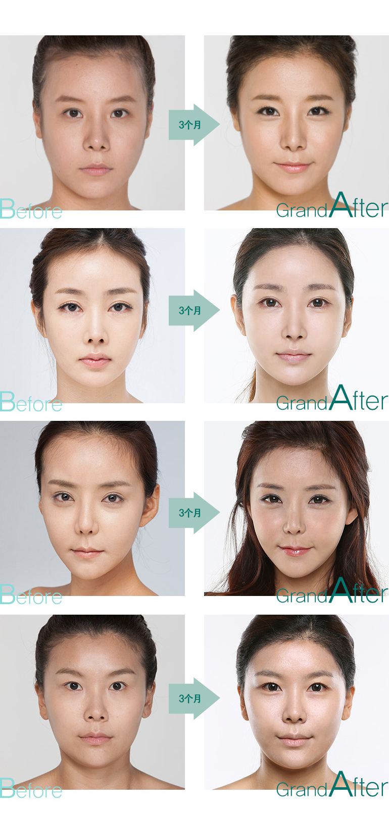 src=http%3A%2F%2Fcn.grandsurgery.com%2Fwordpress%2Fwp-content%2Fuploads%2F2013%2F07%2Fhair-line_2.jp