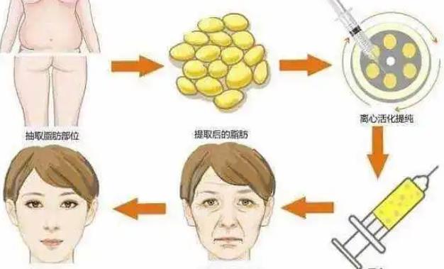 自體脂肪填充的風險有哪些?