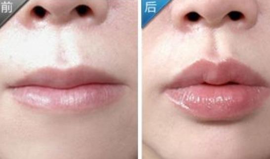 自體脂肪豐唇珠多少錢?