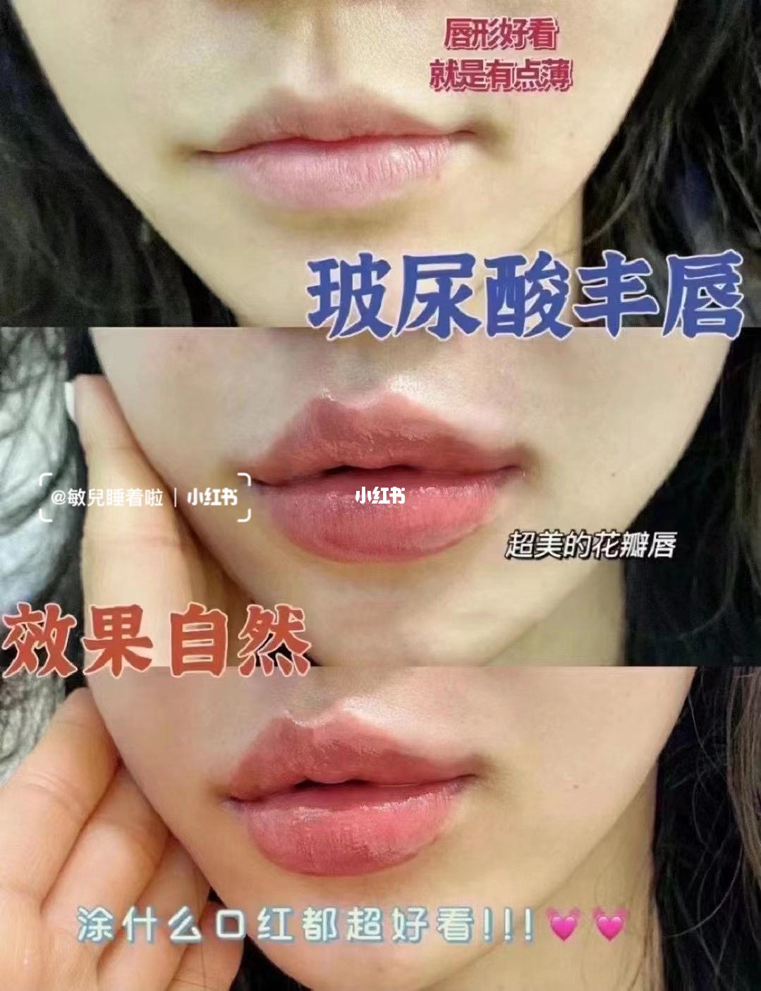 上唇過長怎么辦?上唇過長可以矯正嗎?