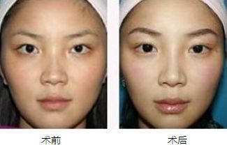 有必要做眉弓隆高術(shù)嗎?假體隆眉弓和透明質(zhì)酸隆眉弓的主要區(qū)別是什么?