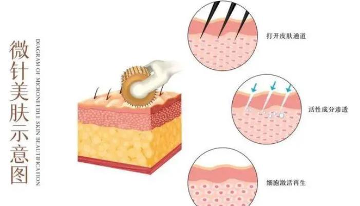 微針祛痘印的原理是什么，有什么優(yōu)勢