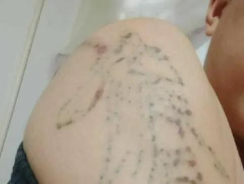 為什么激光洗紋身會(huì)起泡