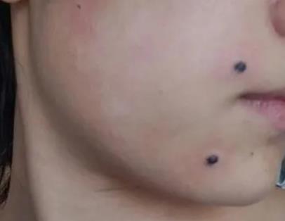 為什么激光點(diǎn)痣后會(huì)復(fù)發(fā)