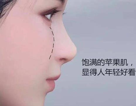 蘋果肌下垂會恢復嗎