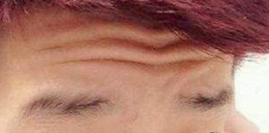 青少年額頭有抬頭紋的原因，應(yīng)該怎么辦