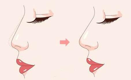 駝峰鼻矯正危險嗎?怎么降低風(fēng)險