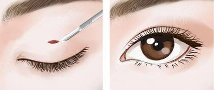 雙眼皮失敗的表現(xiàn)有哪些?雙眼皮修復(fù)高嗎?