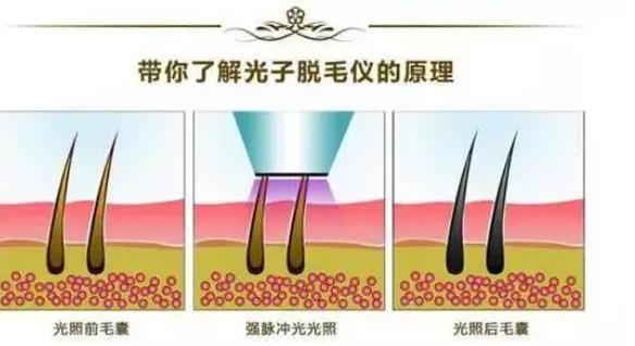 光子脫毛存在哪些風(fēng)險，光子脫毛是怎么做的