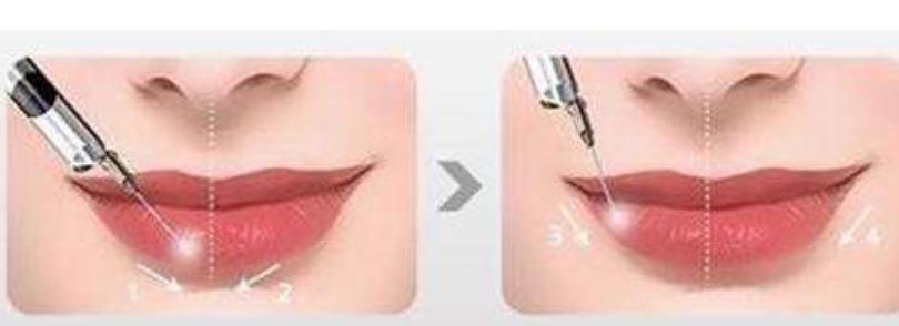 打嘟嘟唇會痛嗎，玻尿酸隆唇后多久會軟化