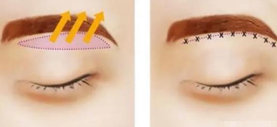 提眉術(shù)和切眉術(shù)是同一個(gè)手術(shù)嗎?提眉術(shù)和切眉術(shù)有什么區(qū)別?