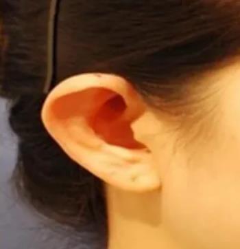 如何糾正招風(fēng)耳?招風(fēng)耳整形什么時(shí)候好