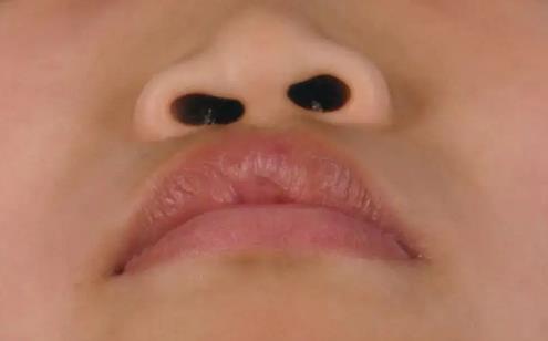 唇裂修復(fù)后畸形的原因是什么?唇裂修復(fù)手術(shù)過(guò)程