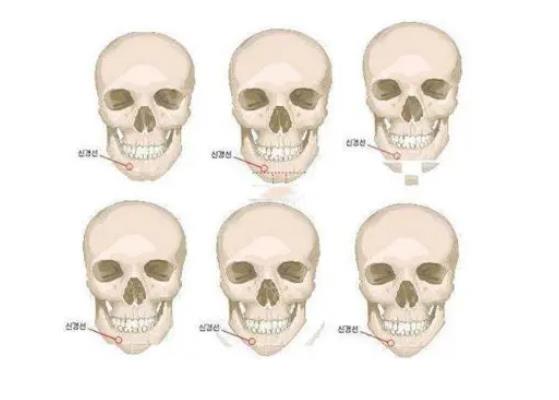 正頜骨手術(shù)有什么后遺癥? 正頜骨手術(shù)后需要注意什么?