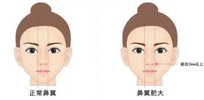 鼻翼縮小手術(shù)的注意事項有哪些?