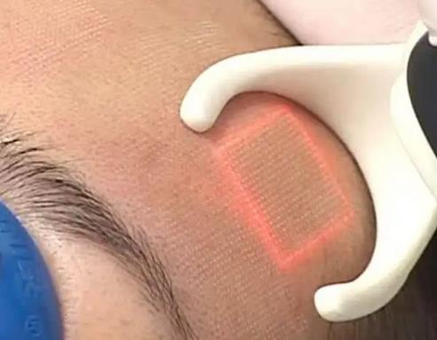 點(diǎn)陣激光疼嗎，點(diǎn)陣激光有什么優(yōu)點(diǎn)?