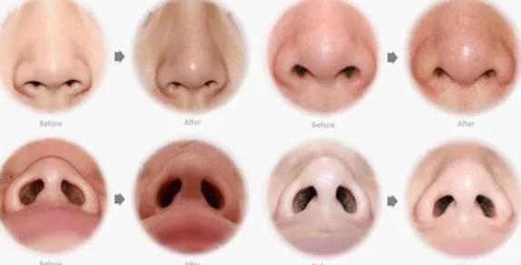 鼻孔縮小是*性的嗎?會反彈嗎?