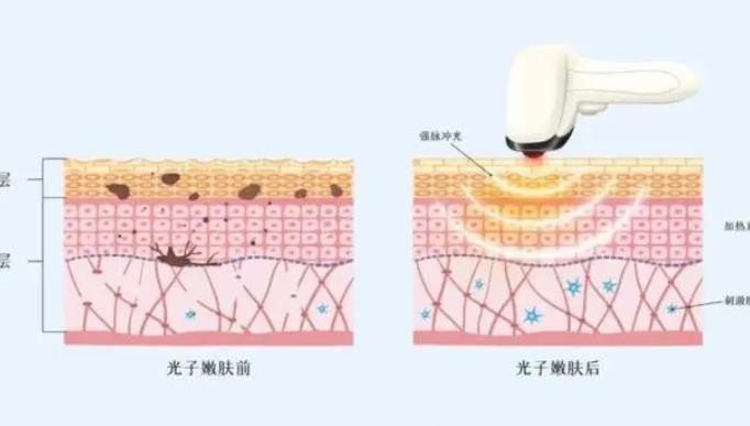 光子嫩膚原理是什么，光子嫩膚有哪三大優(yōu)勢(shì)