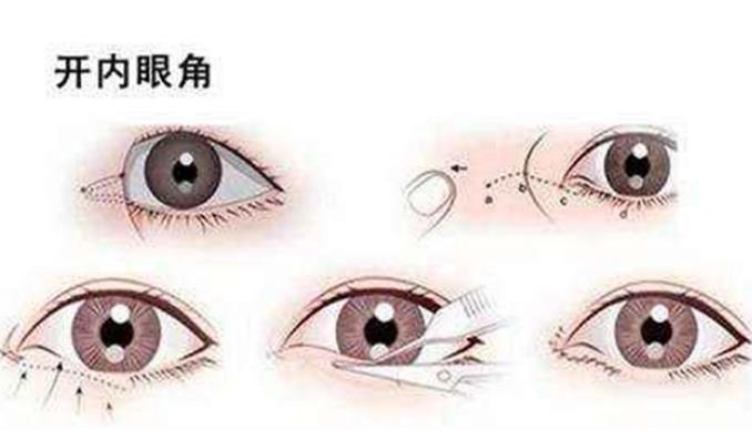 開內(nèi)眼角的副作用有哪些?在哪開眼角比較好?