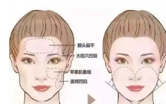 哪些情況適合面部脂肪填充?