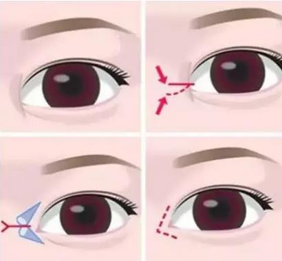 開眼角手術(shù)后恢復(fù)需要多長(zhǎng)時(shí)間?