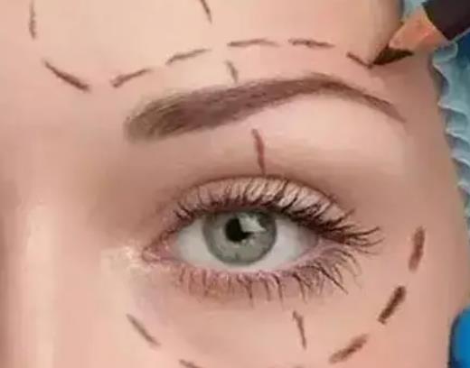 切眉術(shù)之后有什么注意事項(xiàng)，該如何護(hù)理呢？