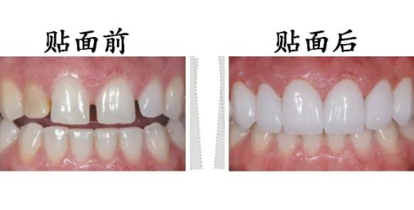 牙齒貼面是什么?需要多少錢？