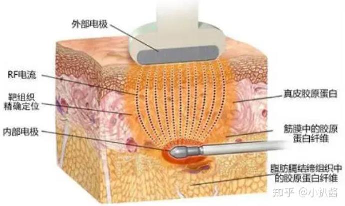 射頻緊膚有什么優(yōu)點(diǎn)?射頻緊膚怎么護(hù)理?