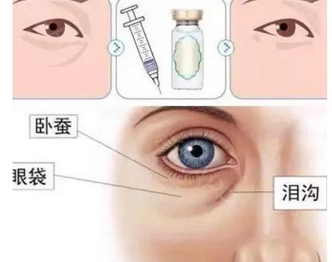 自體脂肪填充淚溝的維持時(shí)間有哪些影響因素?