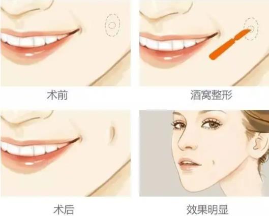 人造酒窩怎么做，需要多少錢？