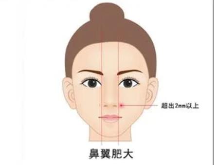 鼻翼縮小有什么后遺癥，怎么正確護理避免