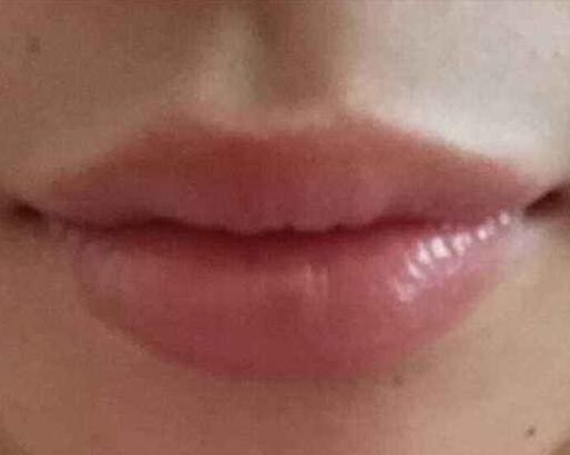 嘴唇外翻矯正多少錢?唇外翻矯正后如何避免后遺癥?