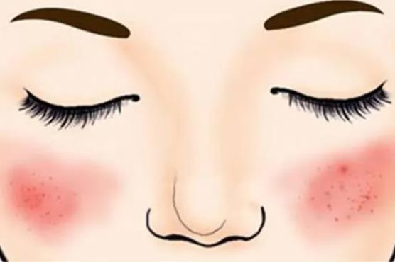 怎么避免激光去除紅血絲后復(fù)發(fā)？去除紅血絲有什么秘方?