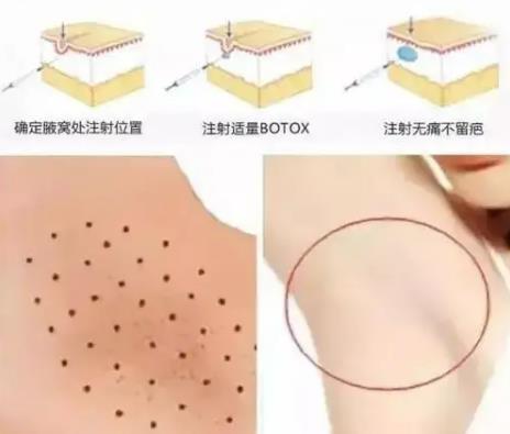 注射去狐臭有果嗎?能治好嗎?