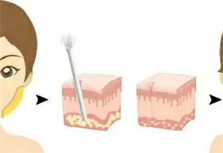 水動(dòng)力吸脂有什么優(yōu)點(diǎn)，水動(dòng)力吸脂會(huì)反彈嗎